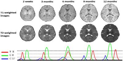 Deep learning techniques for isointense infant brain tissue segmentation: a systematic literature review